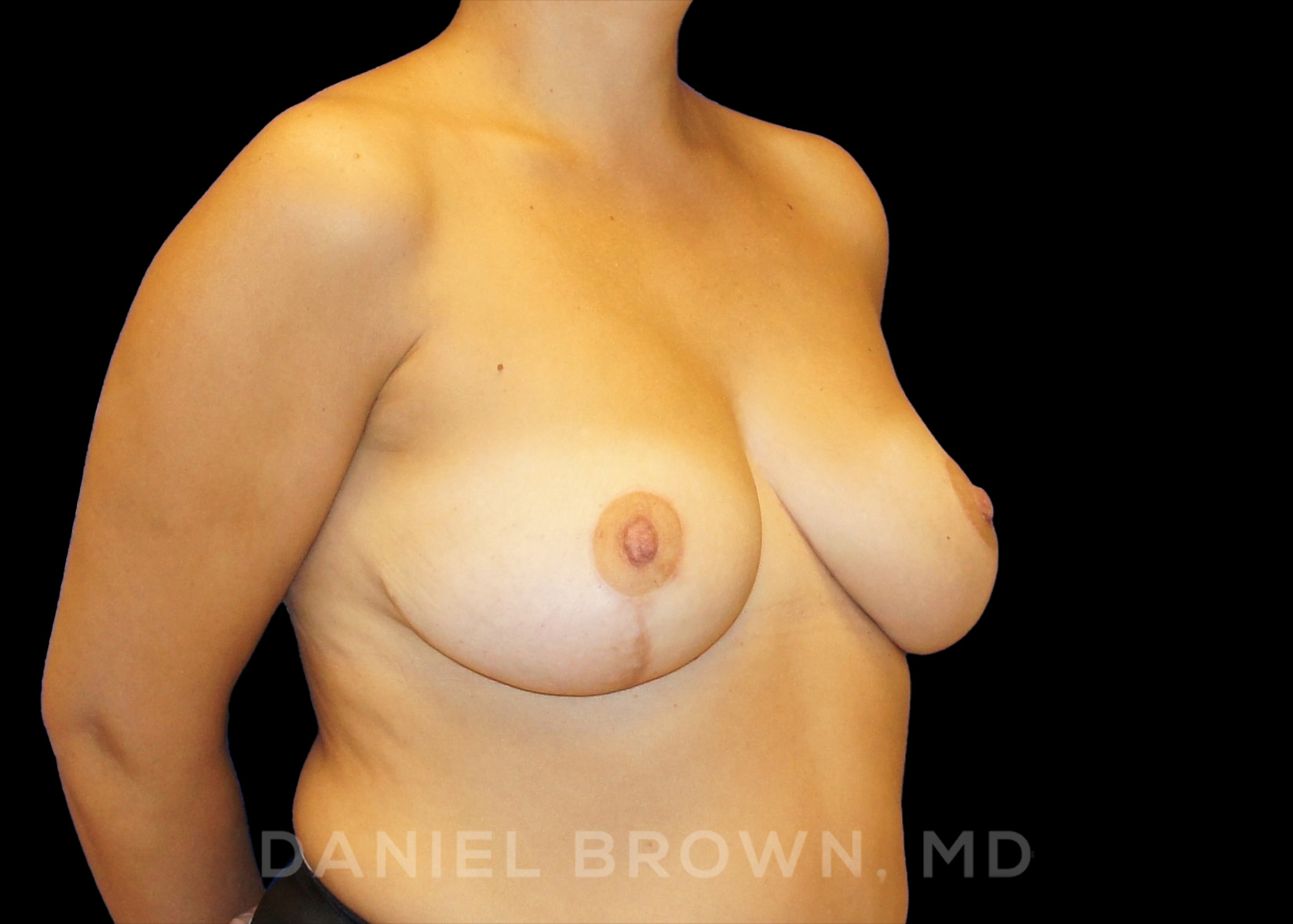 Breast Reduction Patient Photo - Case 1966 - after view-4