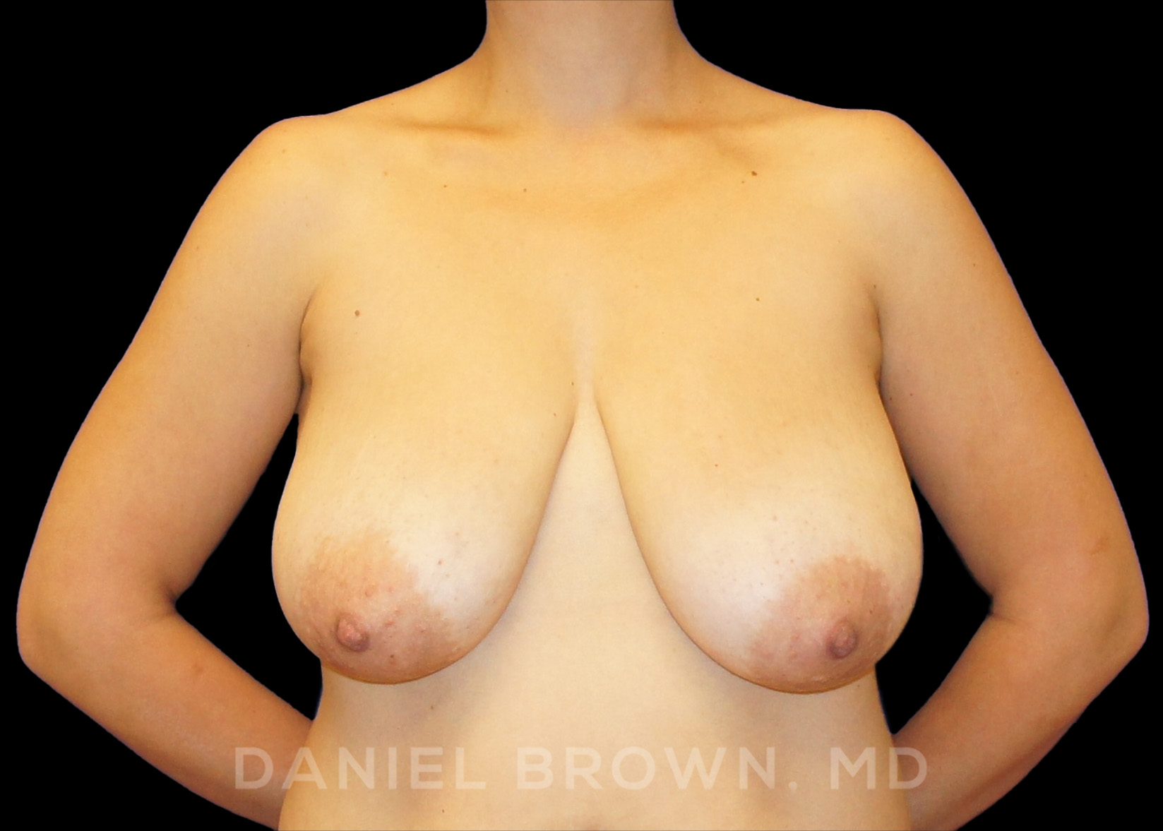 Breast Reduction Patient Photo - Case 1966 - after view-0