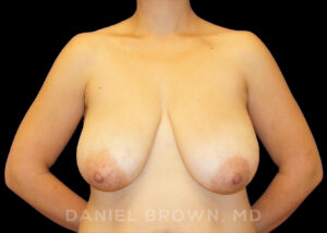 Breast Reduction - Case 1966 - Before
