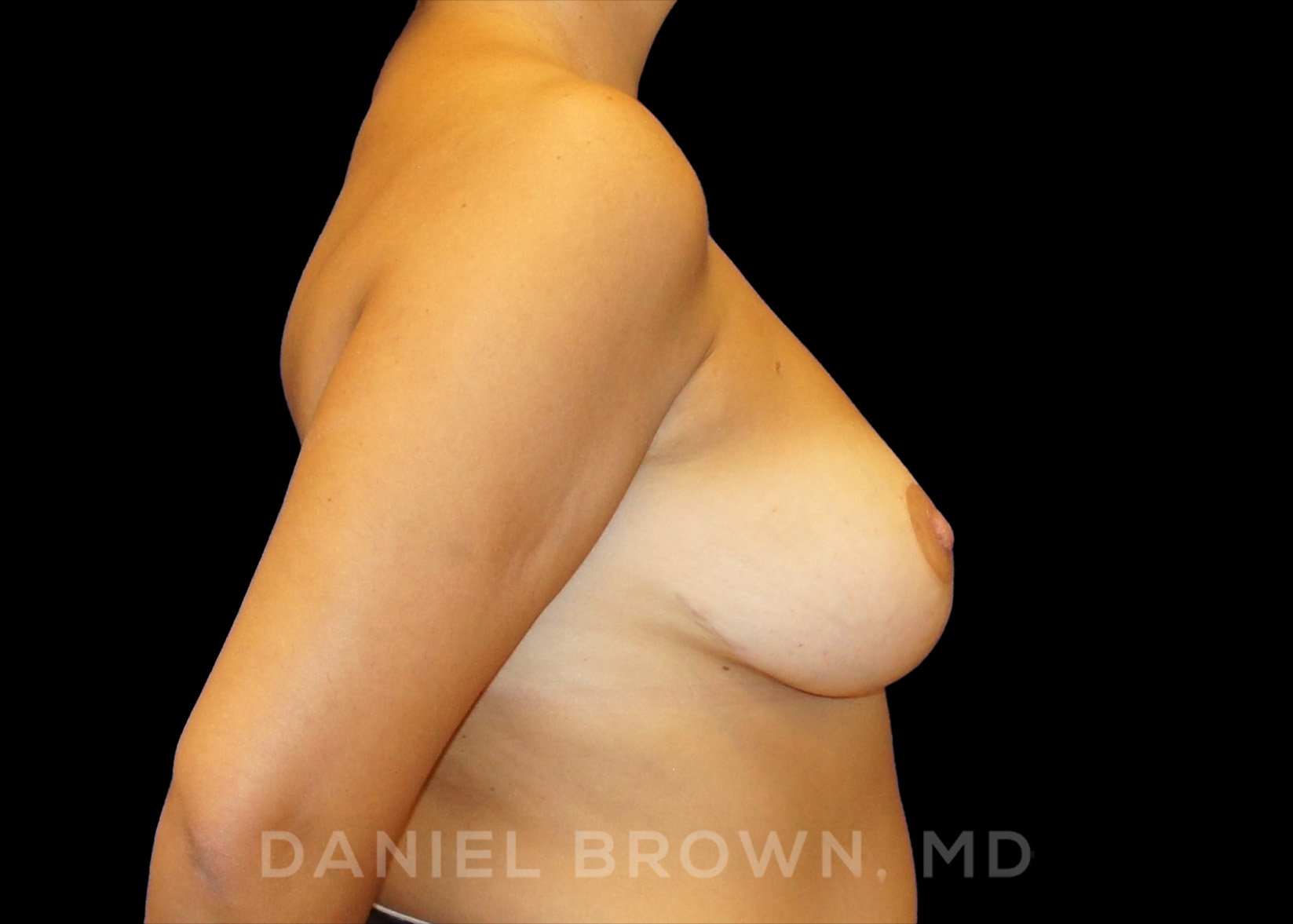 Breast Reduction Patient Photo - Case 1966 - after view-6