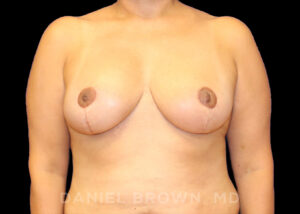 Breast Reduction - Case 1977 - After