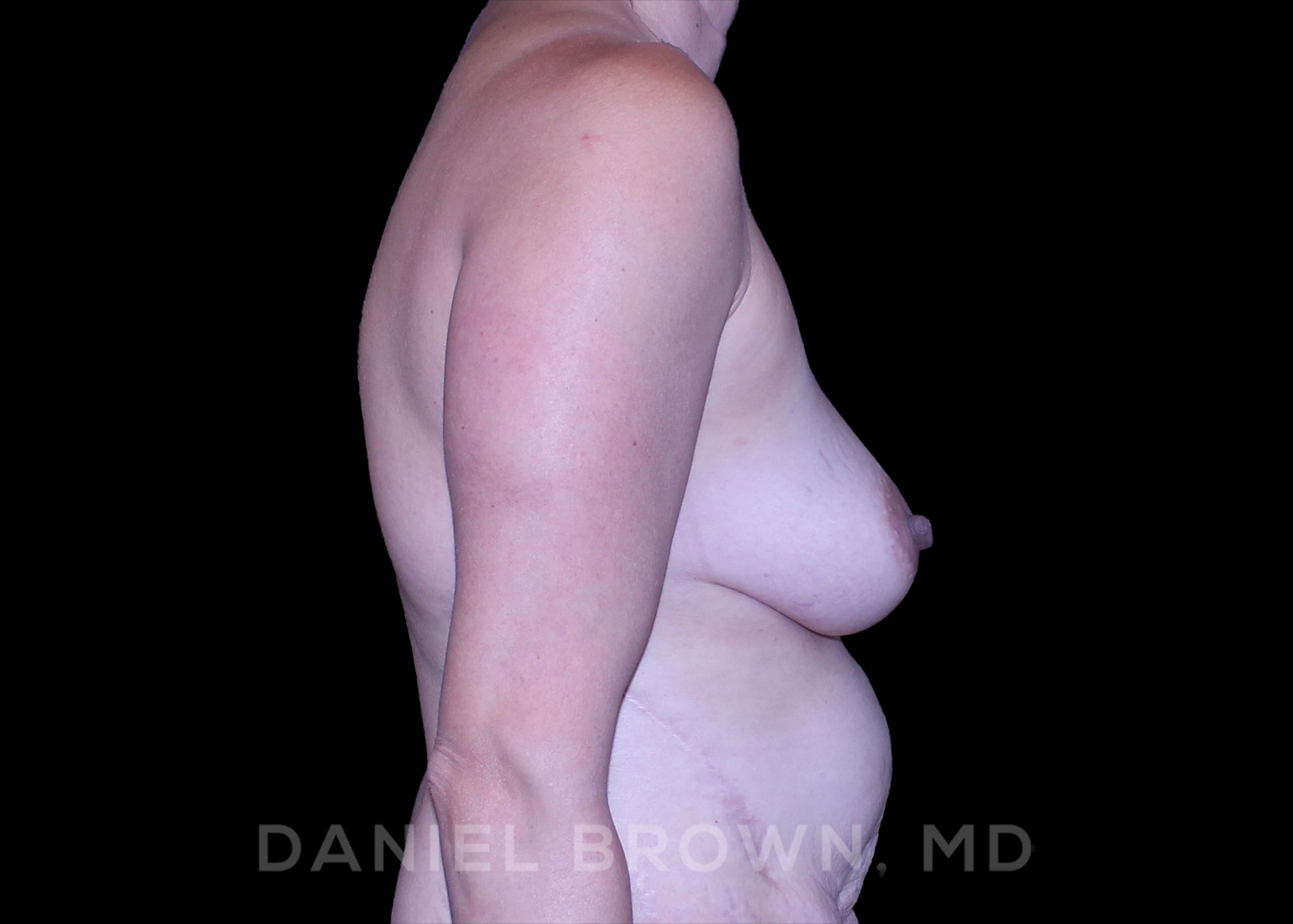 Fat Transfer Patient Photo - Case 1999 - before view-4