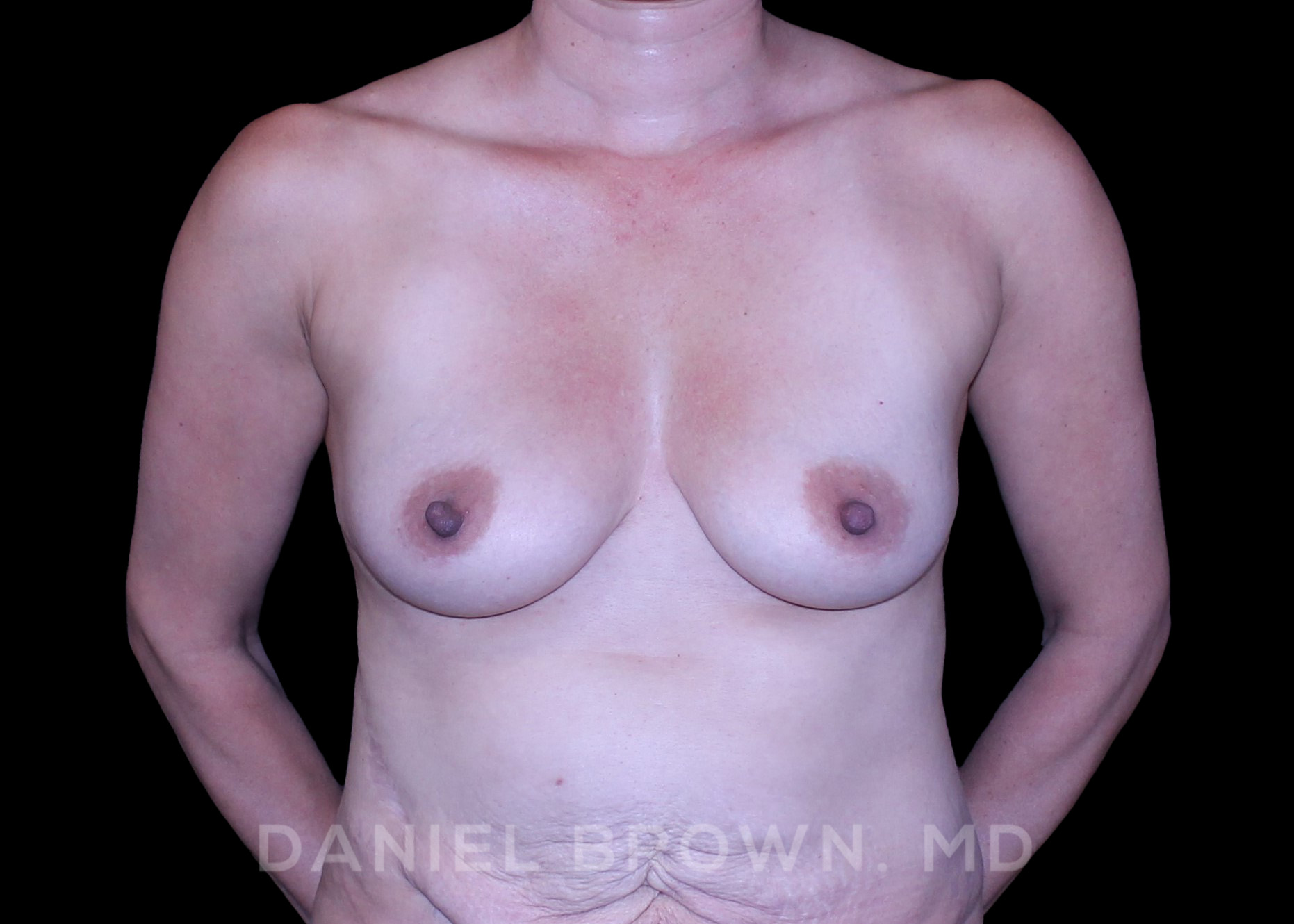 Fat Transfer Patient Photo - Case 1999 - before view-0