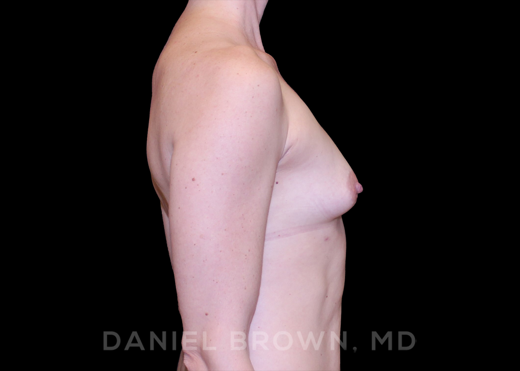 Fat Transfer Patient Photo - Case 2021 - after view