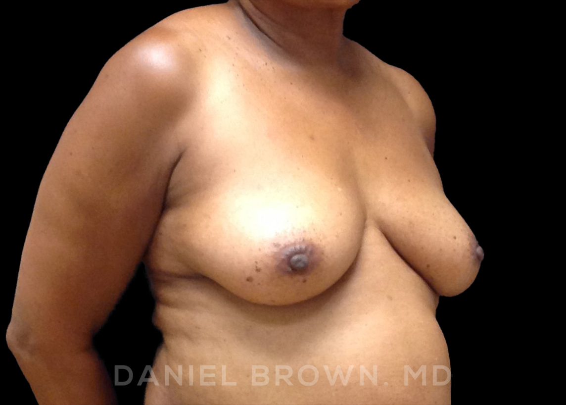 Fat Transfer Patient Photo - Case 2032 - before view-