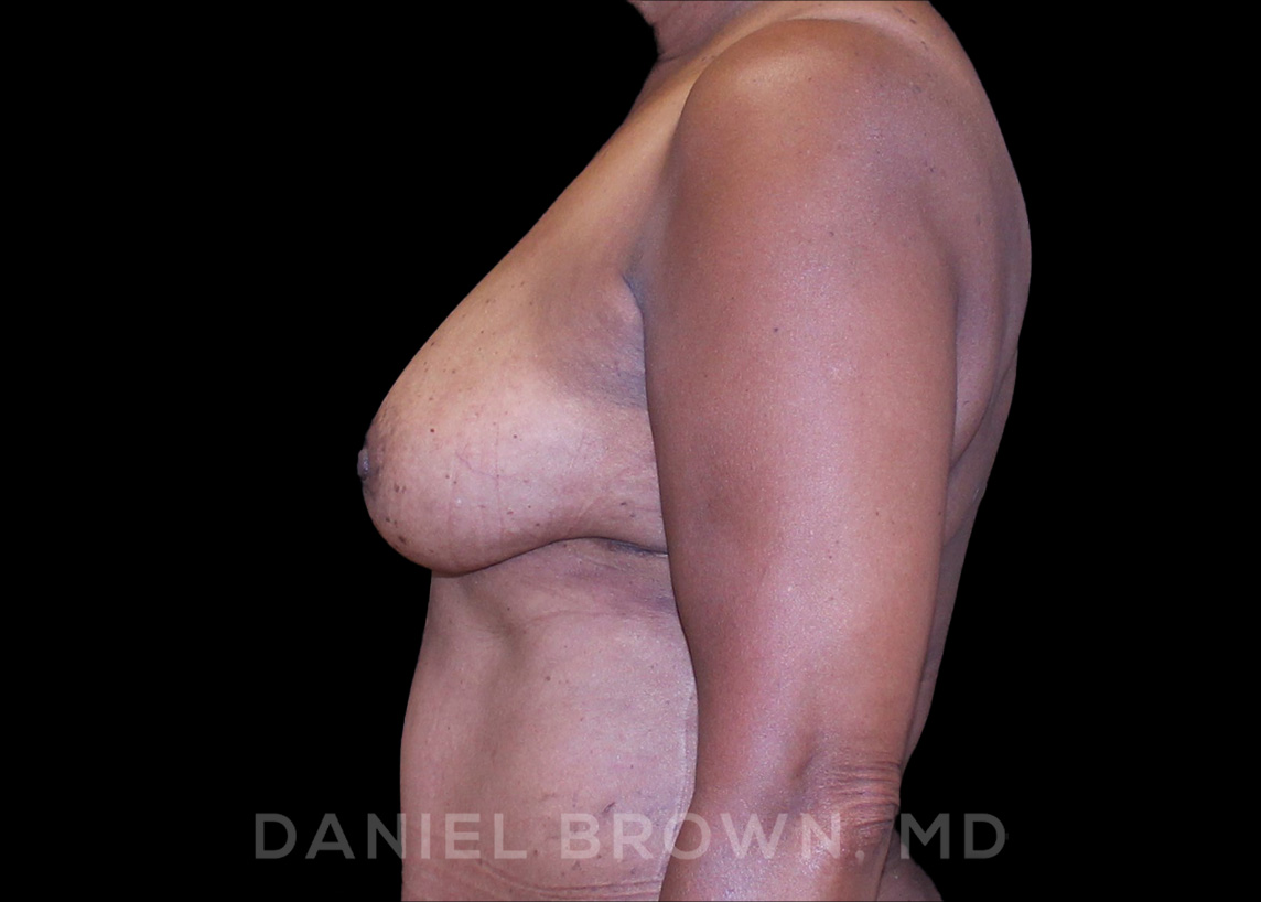 Fat Transfer Patient Photo - Case 2032 - after view-4
