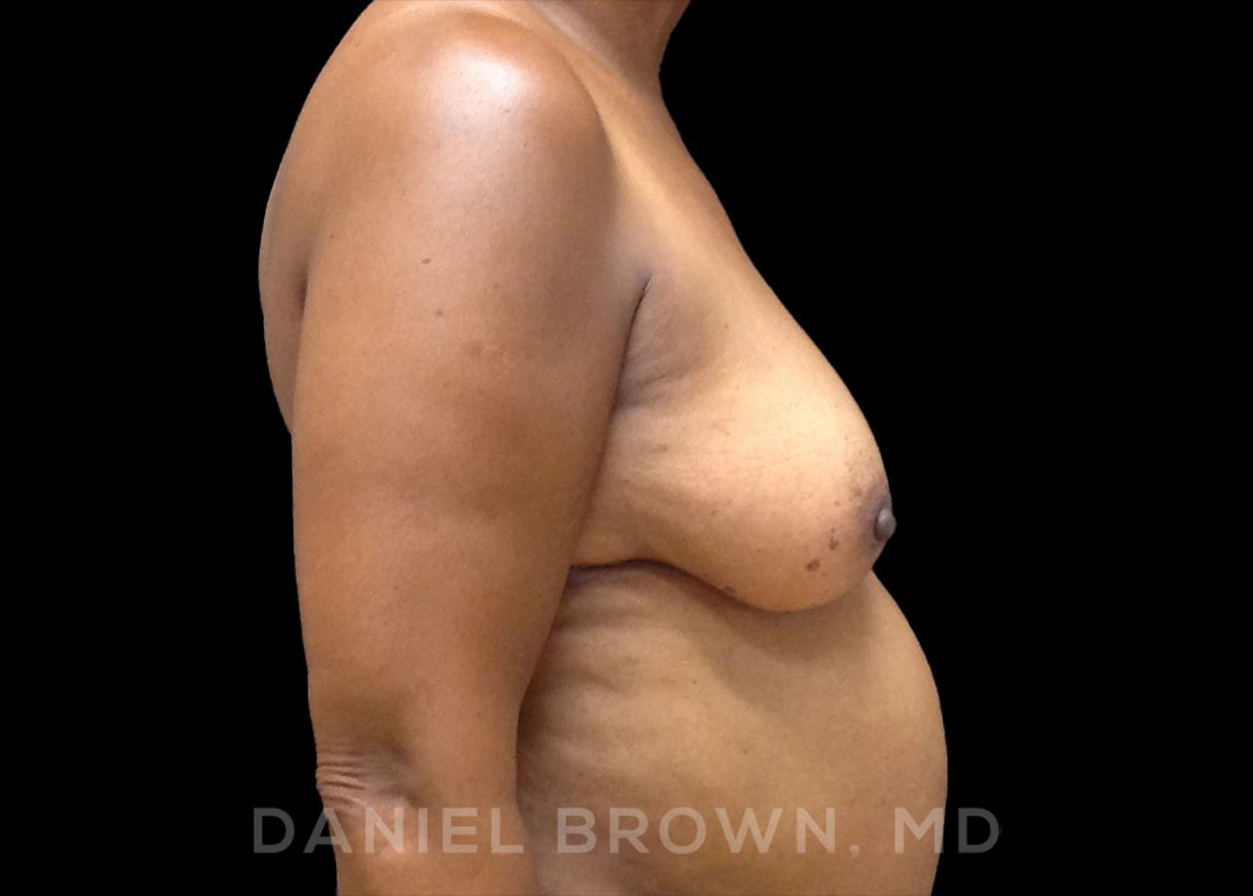 Fat Transfer Patient Photo - Case 2032 - before view-5