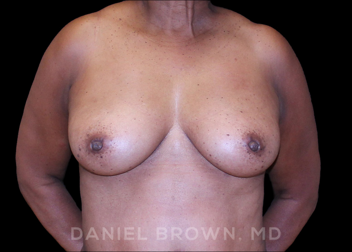 Fat Transfer Patient Photo - Case 2032 - after view-0