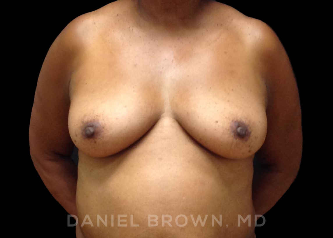 Fat Transfer Patient Photo - Case 2032 - before view-