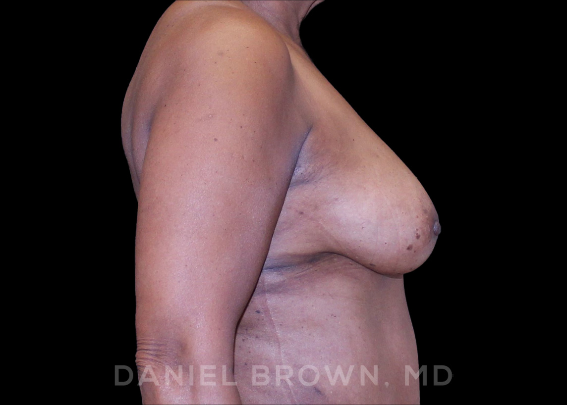 Fat Transfer Patient Photo - Case 2032 - after view-5