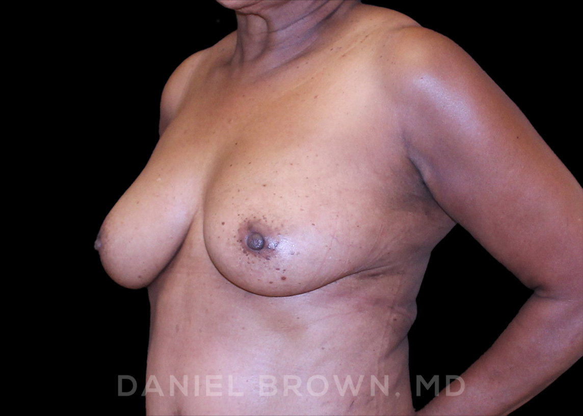 Fat Transfer Patient Photo - Case 2032 - after view-1