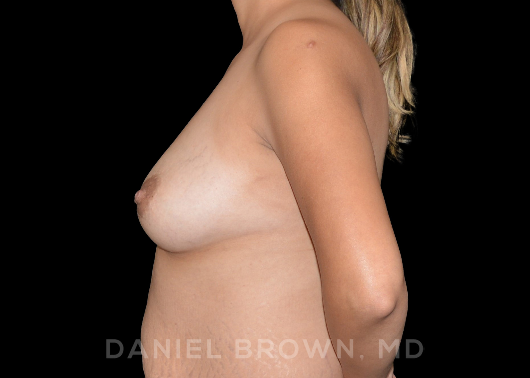 Fat Transfer Patient Photo - Case 2044 - after view-3