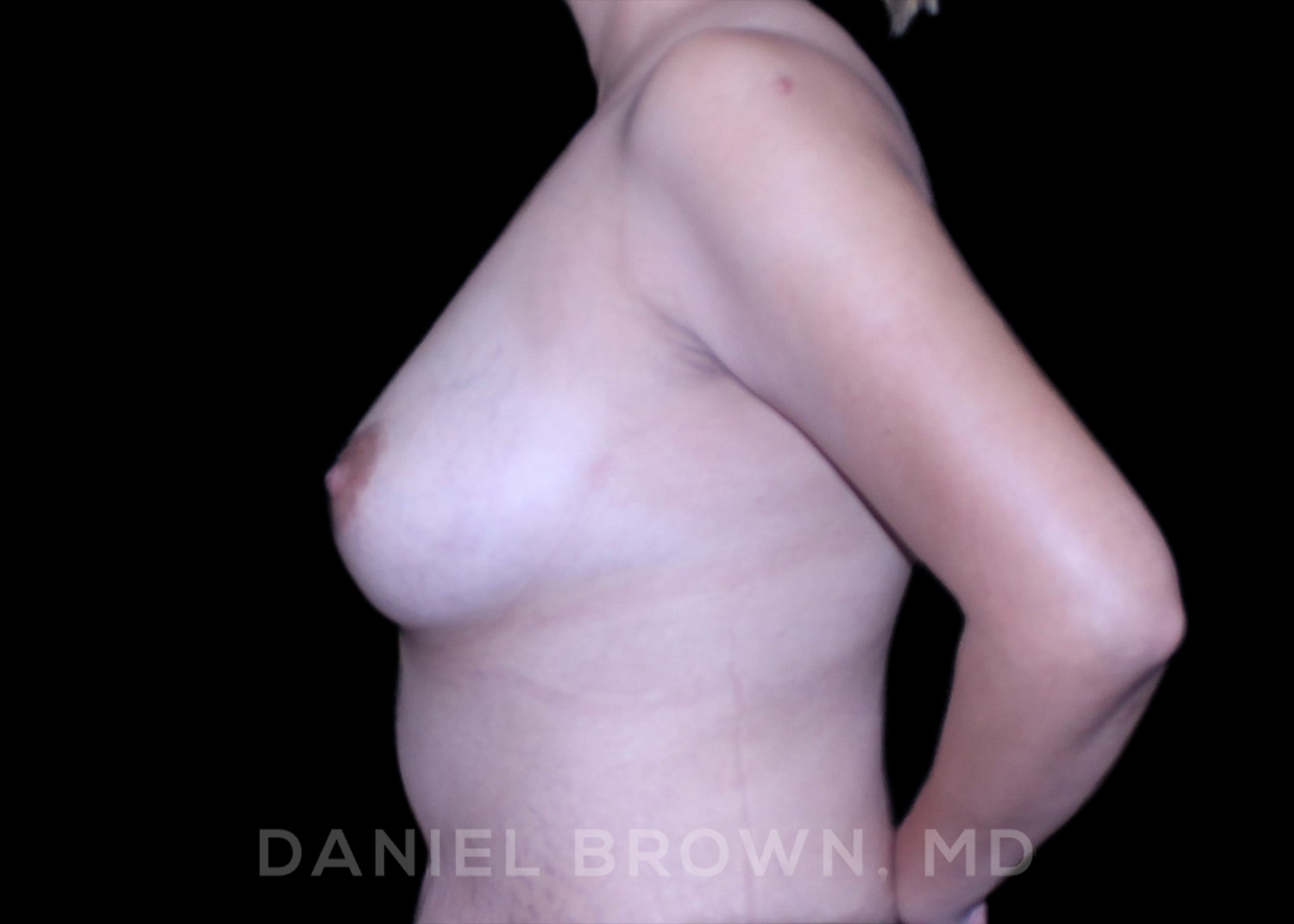 Fat Transfer Patient Photo - Case 2044 - after view-4