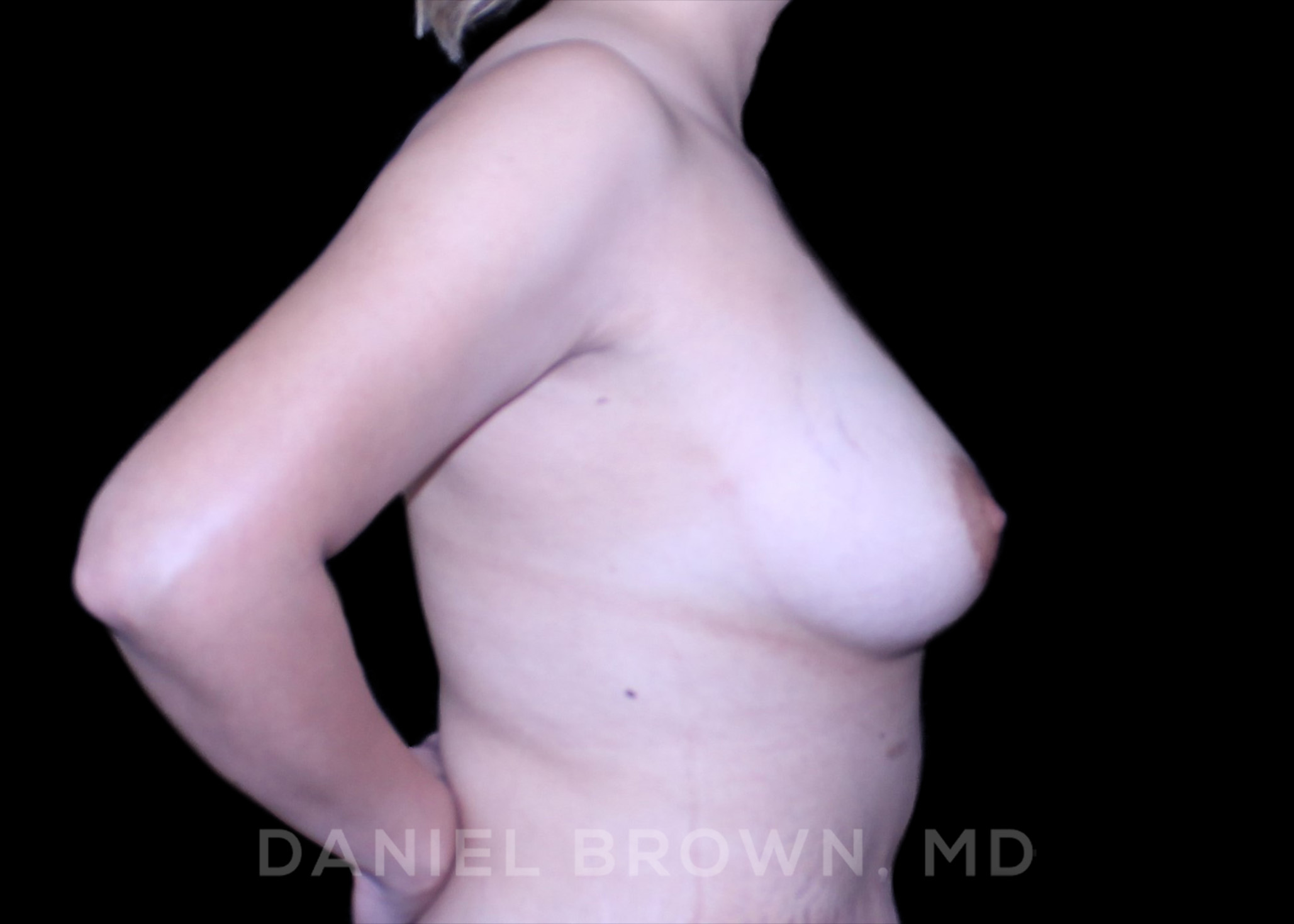Fat Transfer Patient Photo - Case 2044 - after view-5