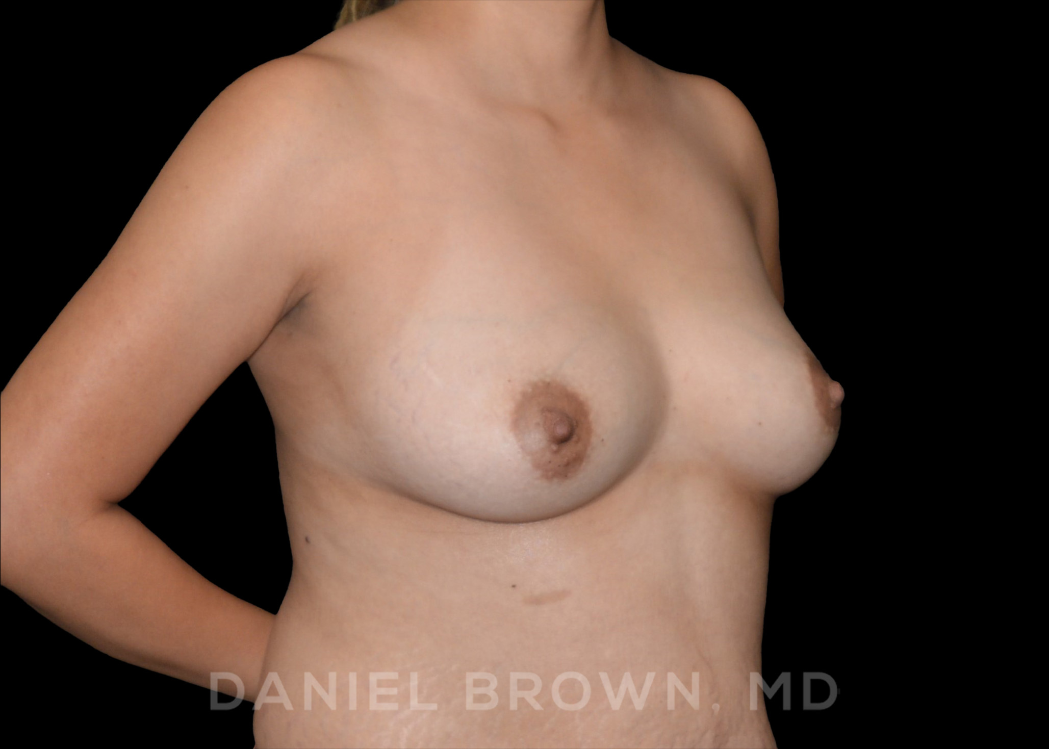 Fat Transfer Patient Photo - Case 2044 - before view-