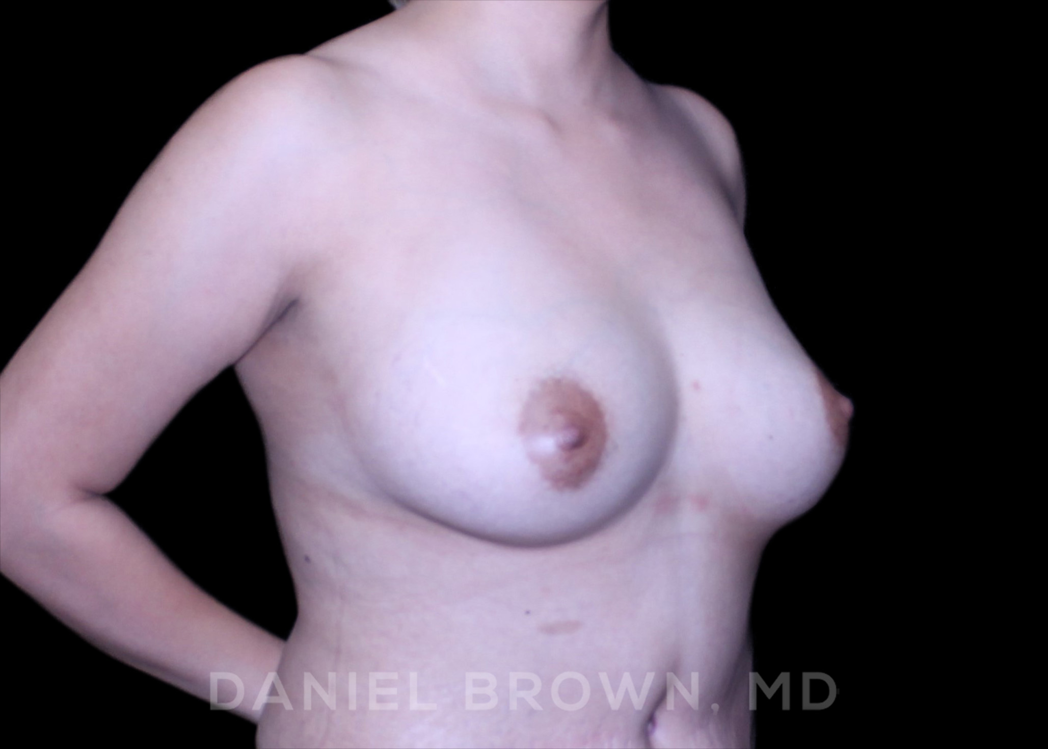 Fat Transfer Patient Photo - Case 2044 - before view-