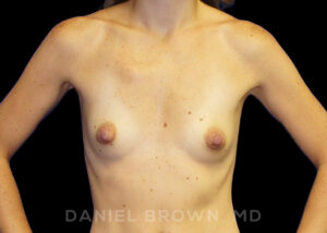 Breast Augmentation - Case 2055 - Before