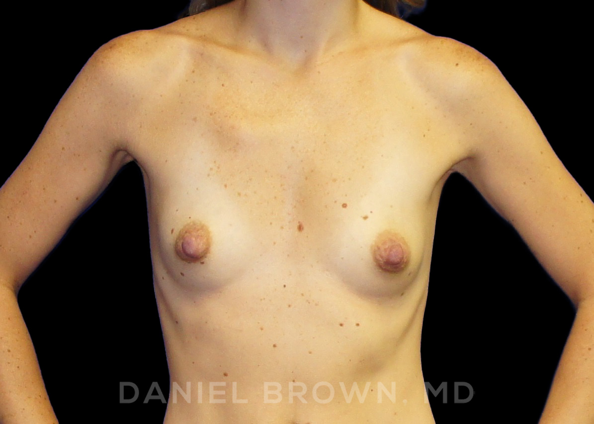 Breast Augmentation Patient Photo - Case 2055 - before view-