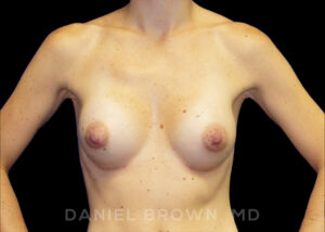 Breast Augmentation - Case 2055 - After
