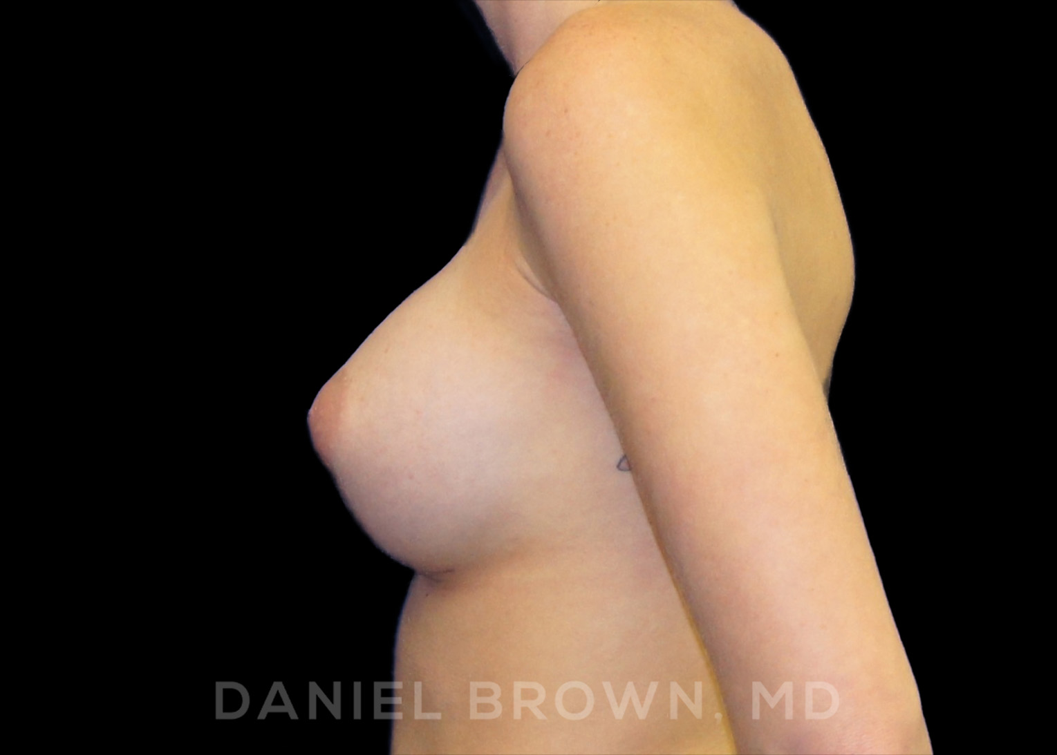 Breast Augmentation Patient Photo - Case 2063 - after view-3