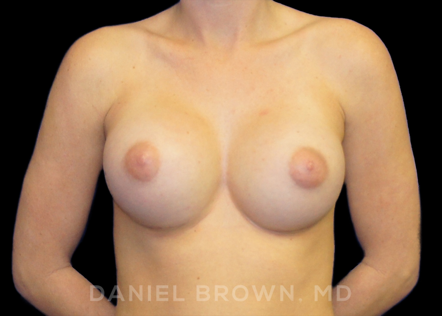 Breast Augmentation Patient Photo - Case 2063 - after view
