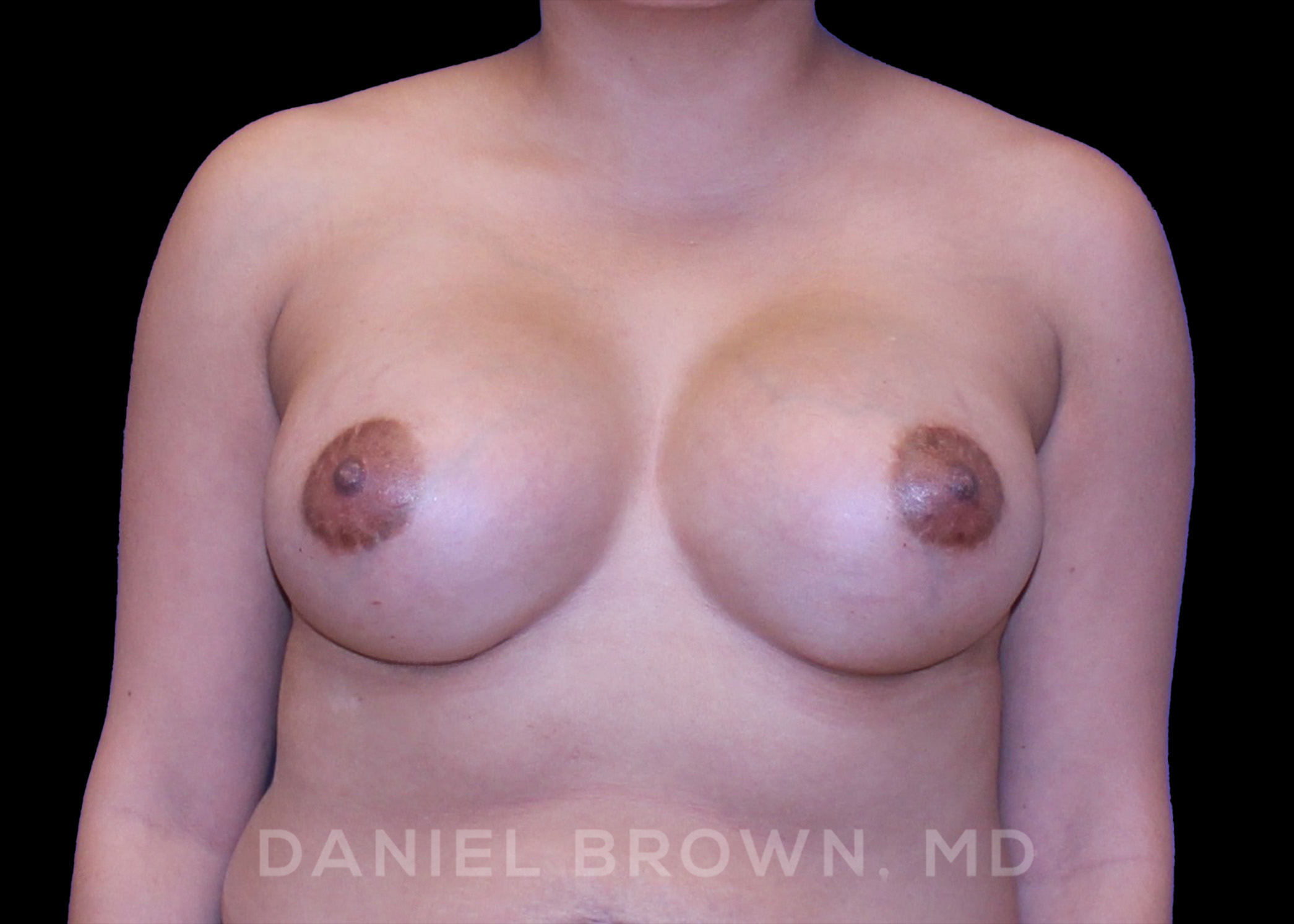 Breast Augmentation Patient Photo - Case 2070 - before view-