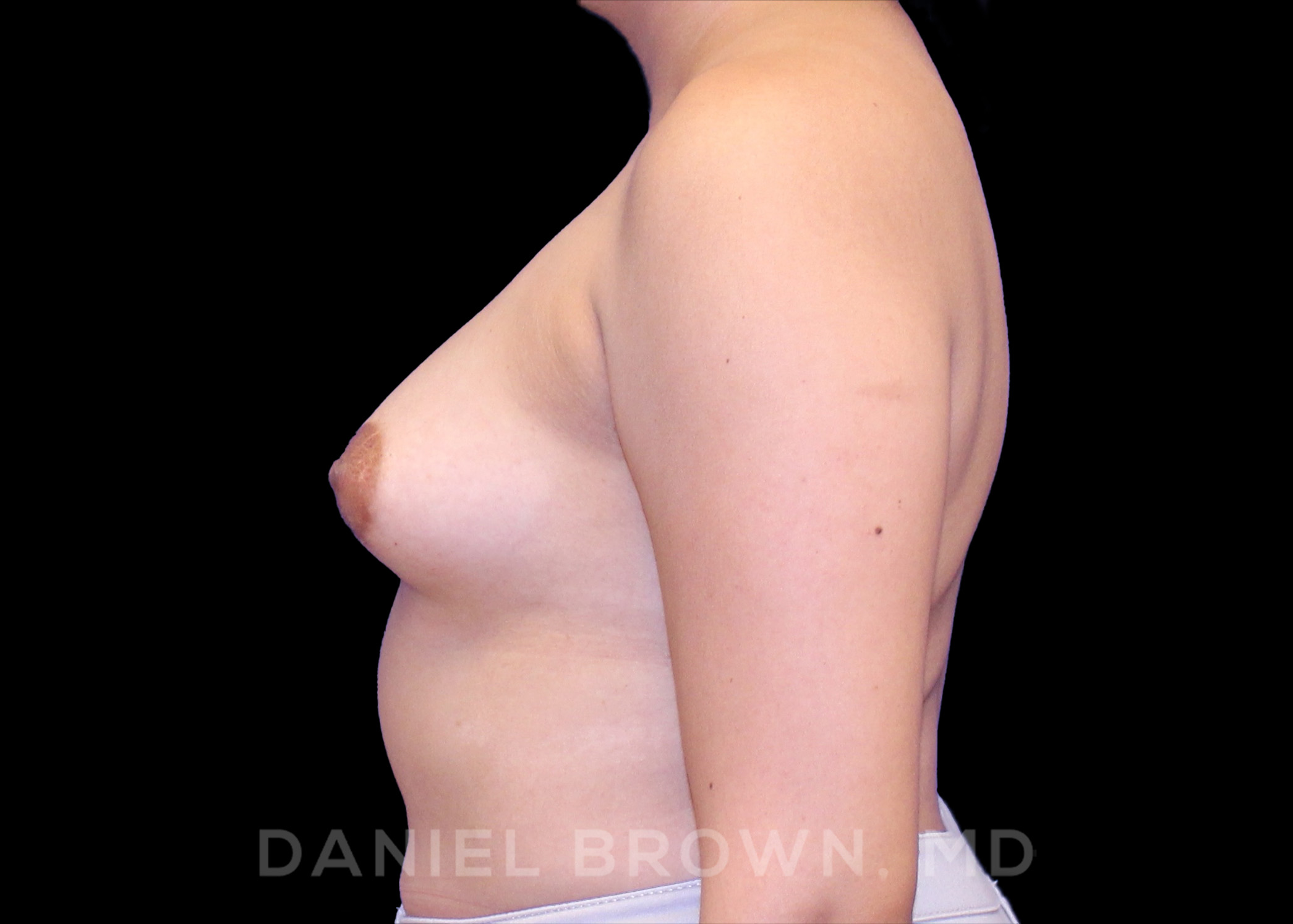 Breast Augmentation Patient Photo - Case 2070 - after view