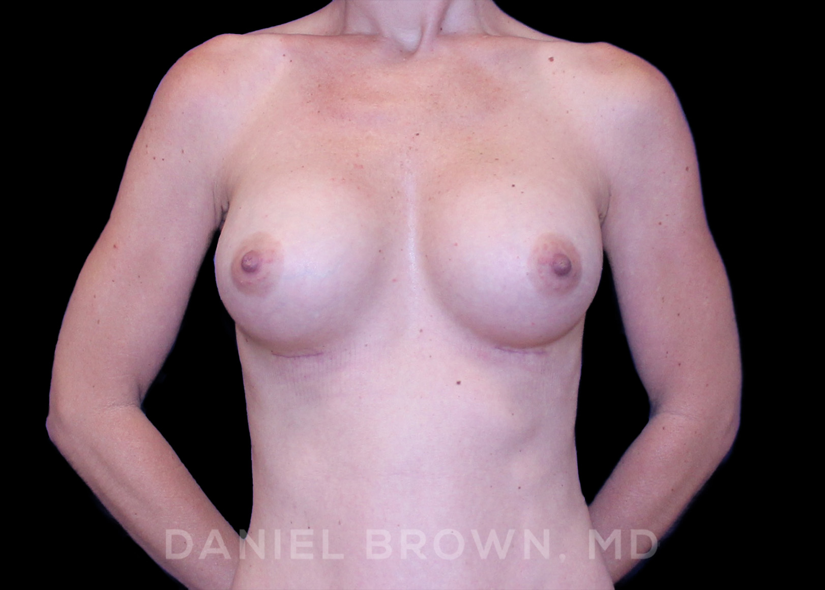 Breast Augmentation Patient Photo - Case 2084 - after view
