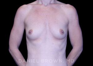 Breast Augmentation - Case 2084 - Before