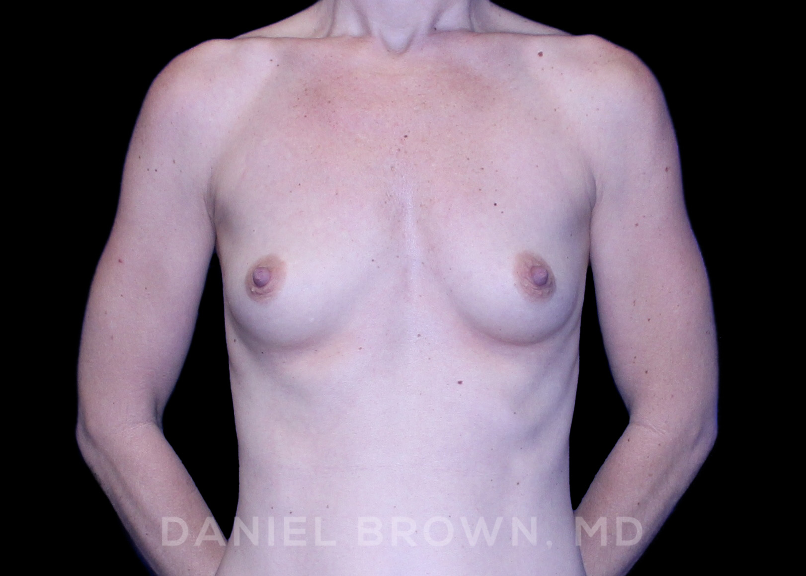 Breast Augmentation Patient Photo - Case 2084 - before view-