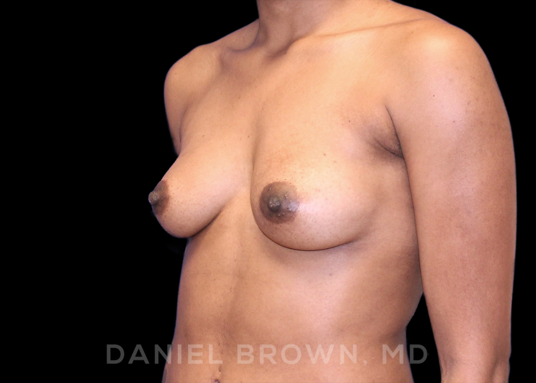 Breast Augmentation Patient Photo - Case 2091 - before view-