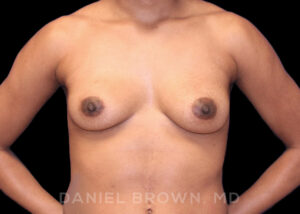 Breast Augmentation - Case 2091 - Before