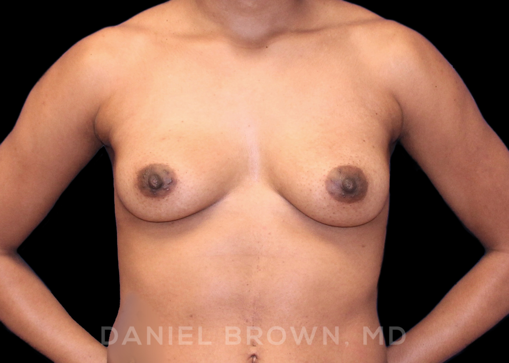 Breast Augmentation Patient Photo - Case 2091 - before view-0