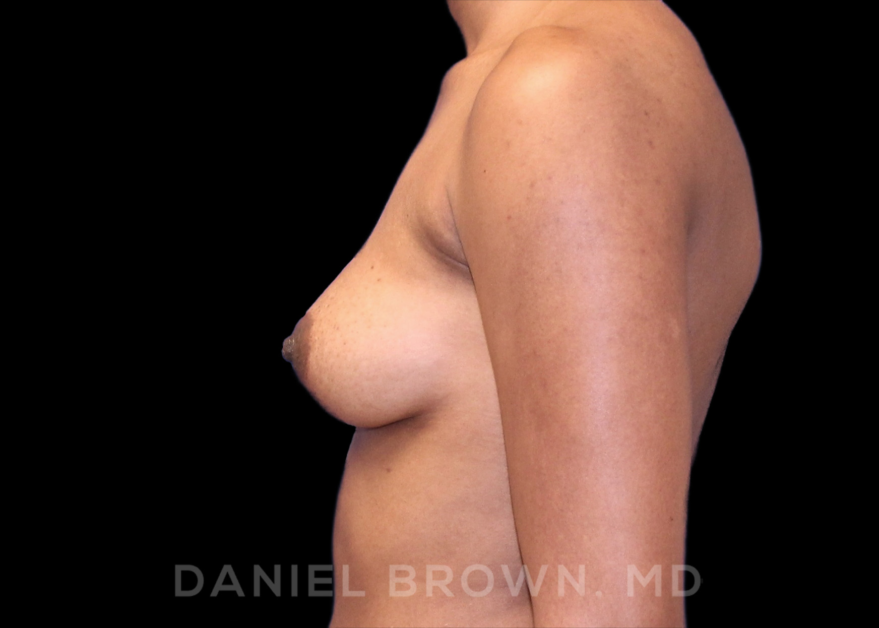 Breast Augmentation Patient Photo - Case 2091 - before view-2