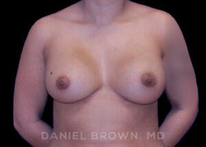 Breast Augmentation - Case 2098 - After