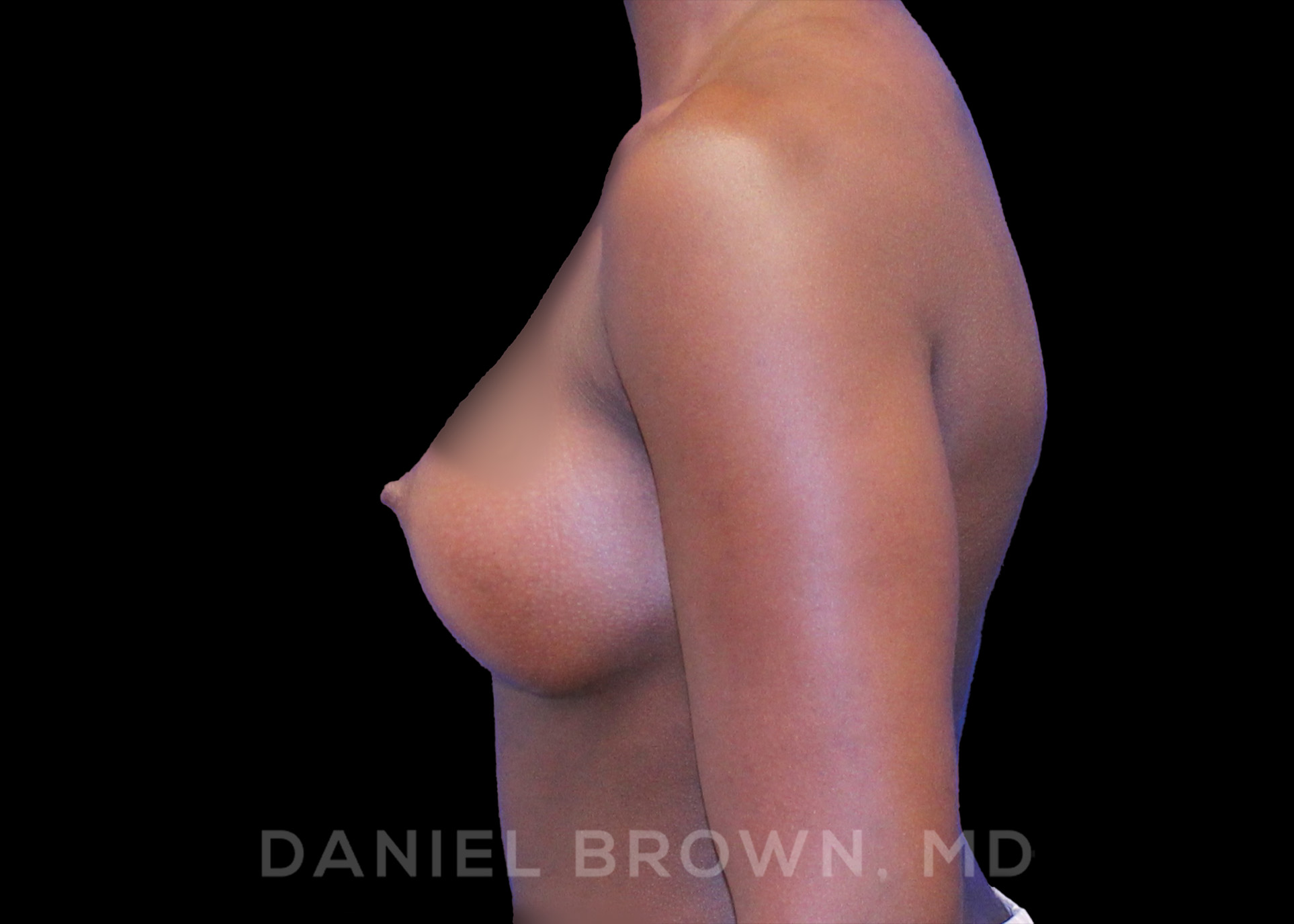 Breast Augmentation Patient Photo - Case 2105 - after view