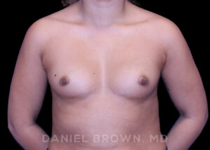 Breast Augmentation - Case 2098 - Before