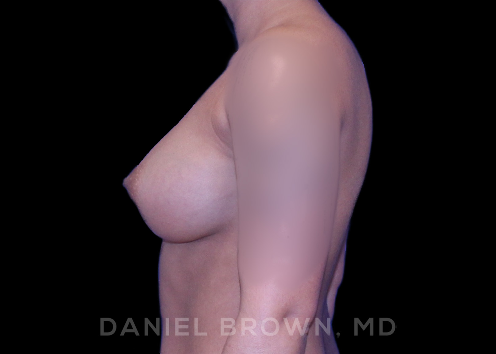 Breast Augmentation Patient Photo - Case 2098 - after view-2