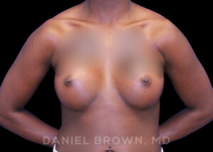 Breast Augmentation - Case 2105 - After