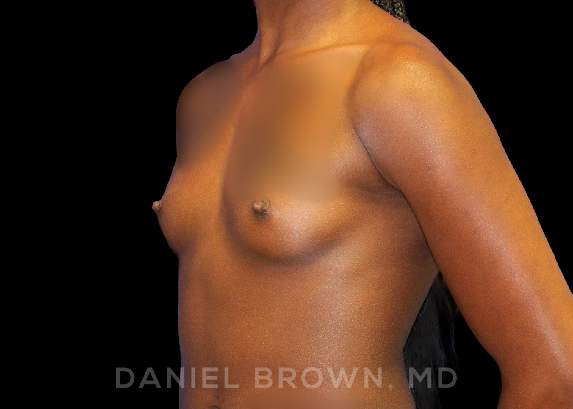 Breast Augmentation Patient Photo - Case 2105 - before view-