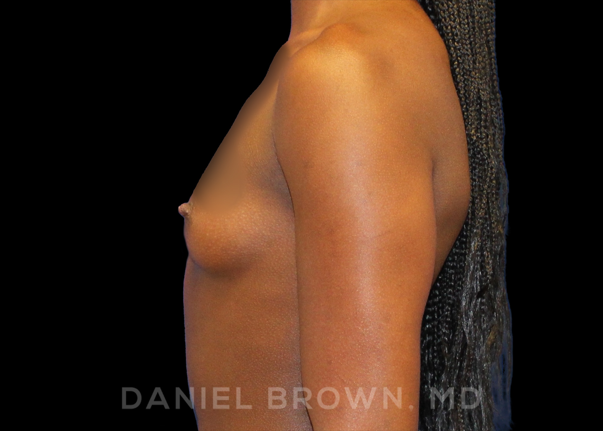 Breast Augmentation Patient Photo - Case 2105 - before view-2