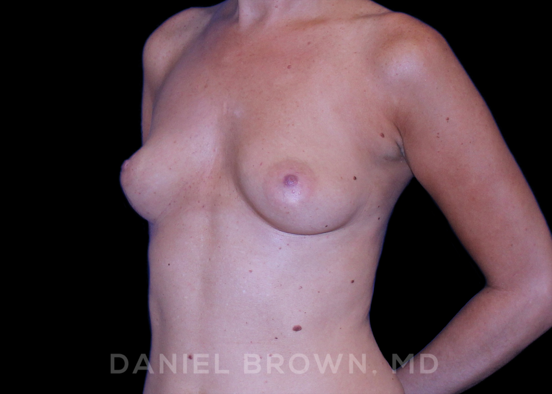 Breast Augmentation Patient Photo - Case 2112 - before view-1