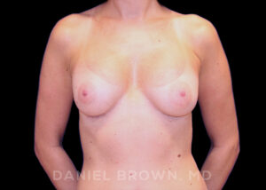 Breast Augmentation - Case 2112 - After