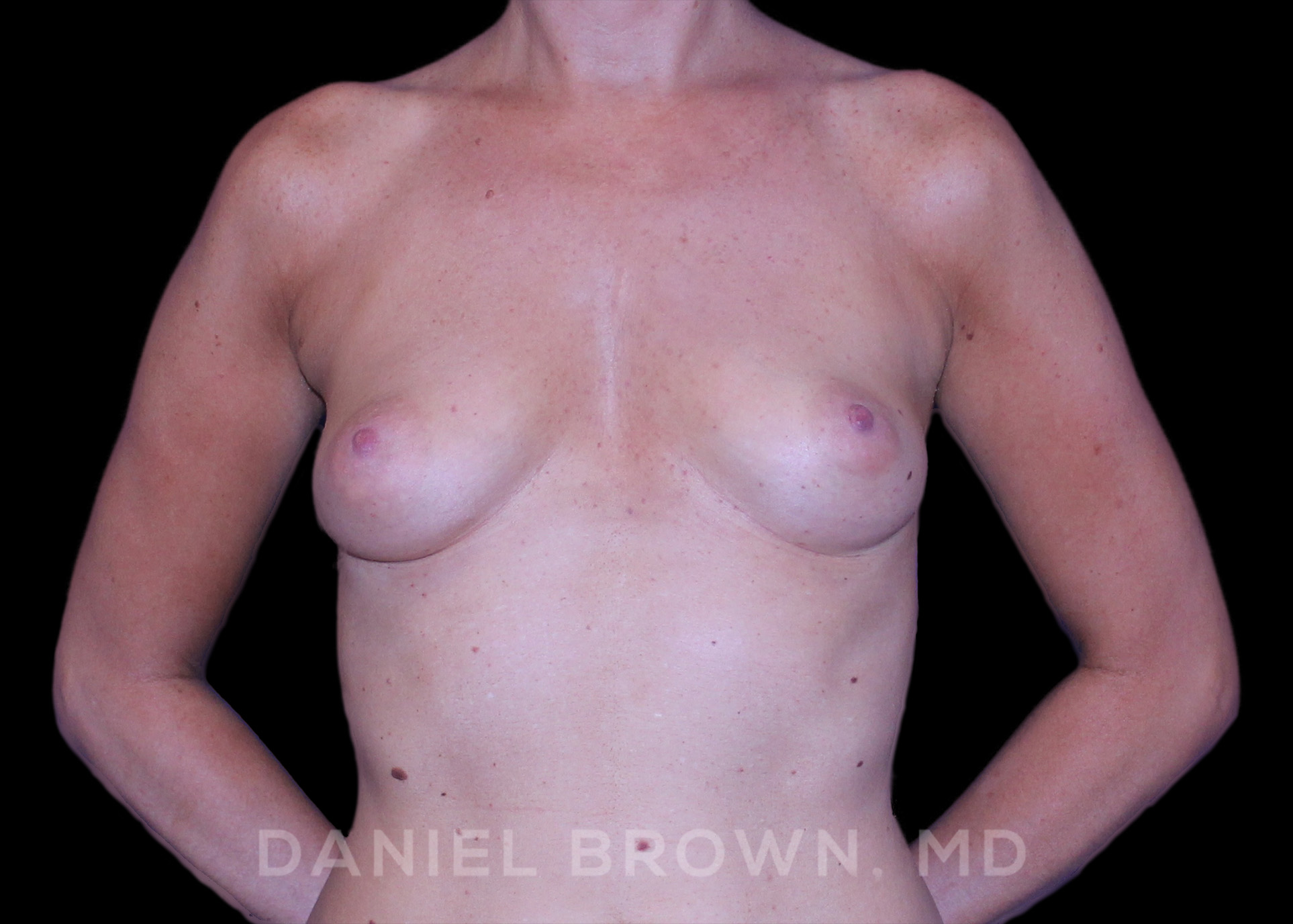 Breast Augmentation Patient Photo - Case 2112 - before view-0