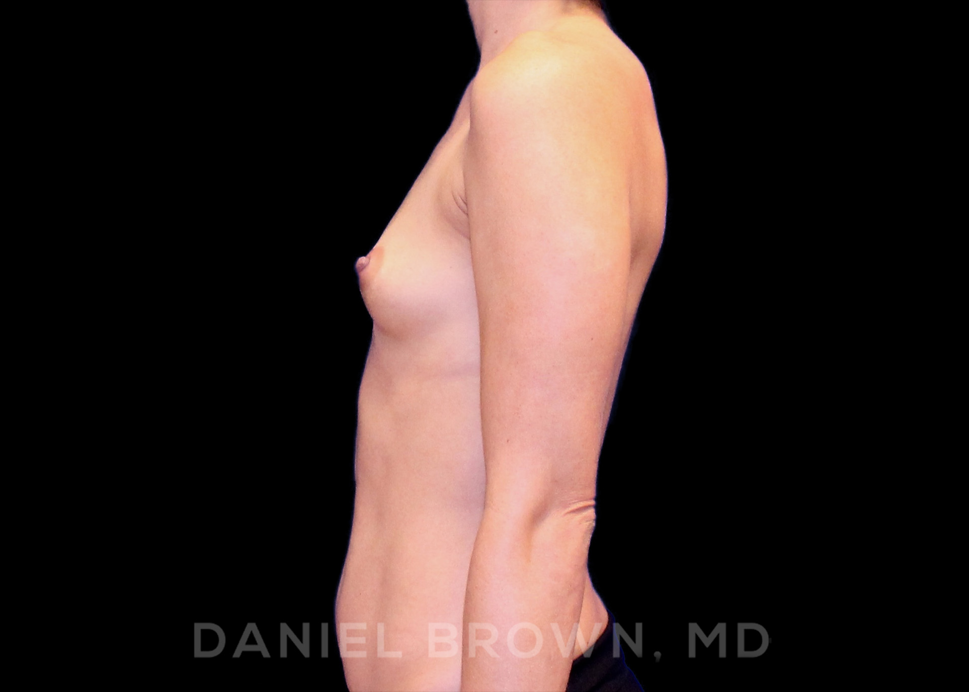 Breast Augmentation Patient Photo - Case 2119 - before view-