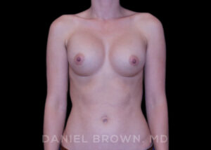 Breast Augmentation - Case 2119 - After