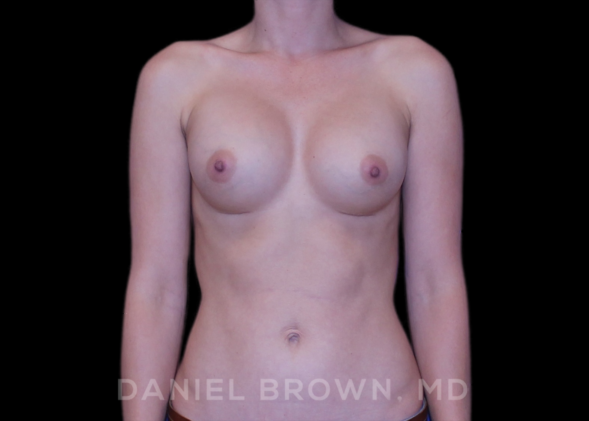 Breast Augmentation Patient Photo - Case 2119 - after view-0