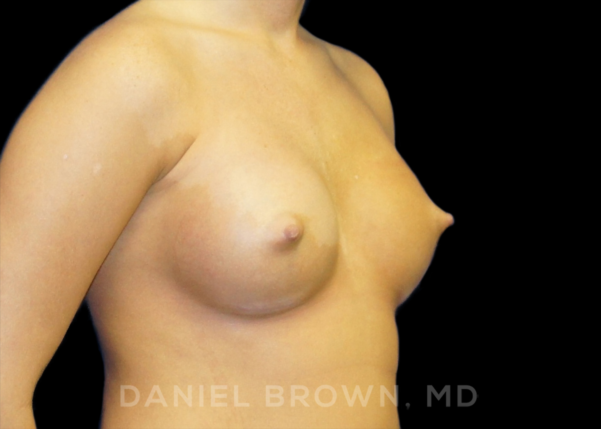 Breast Augmentation Patient Photo - Case 2126 - after view