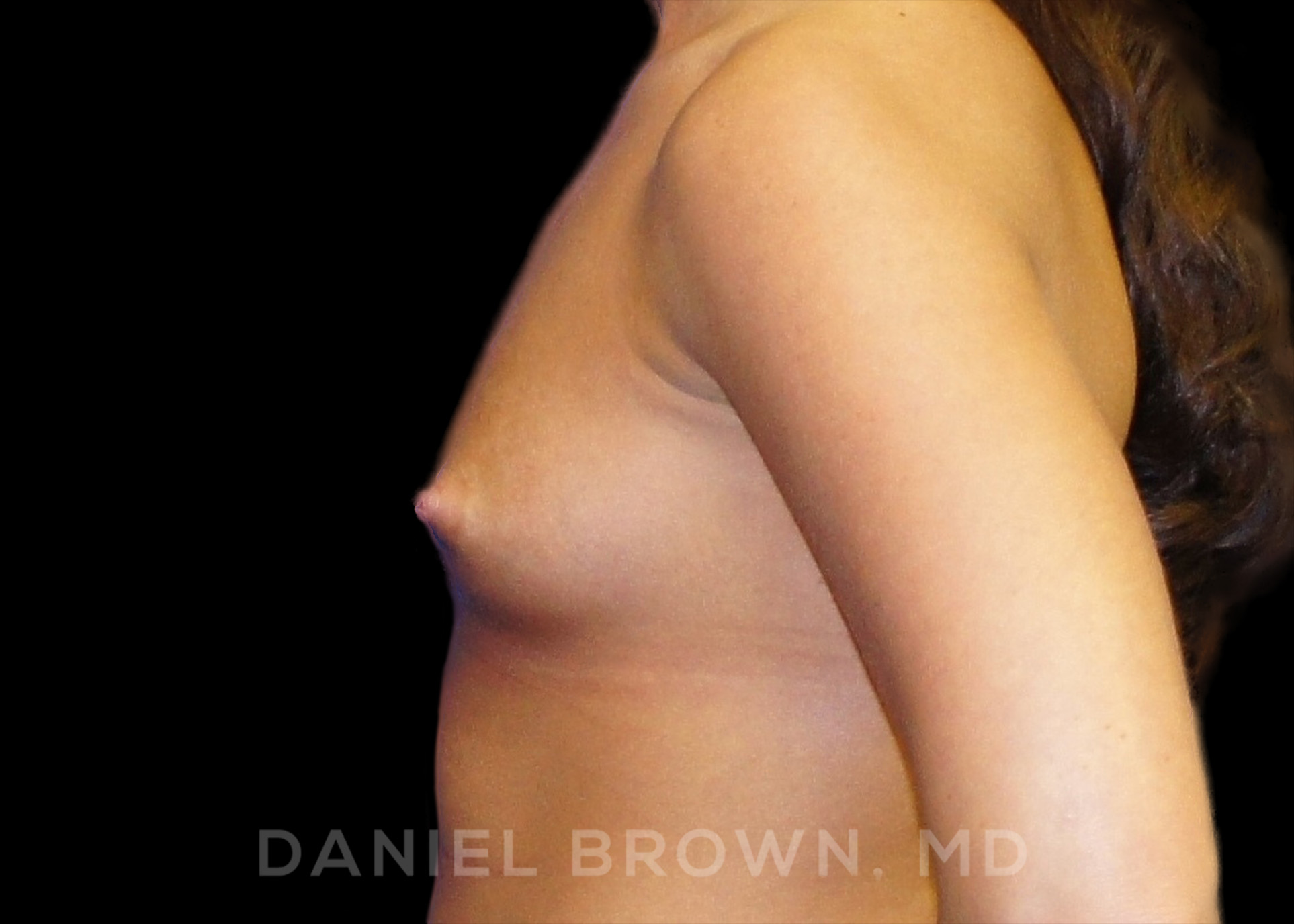 Breast Augmentation Patient Photo - Case 2126 - before view-3