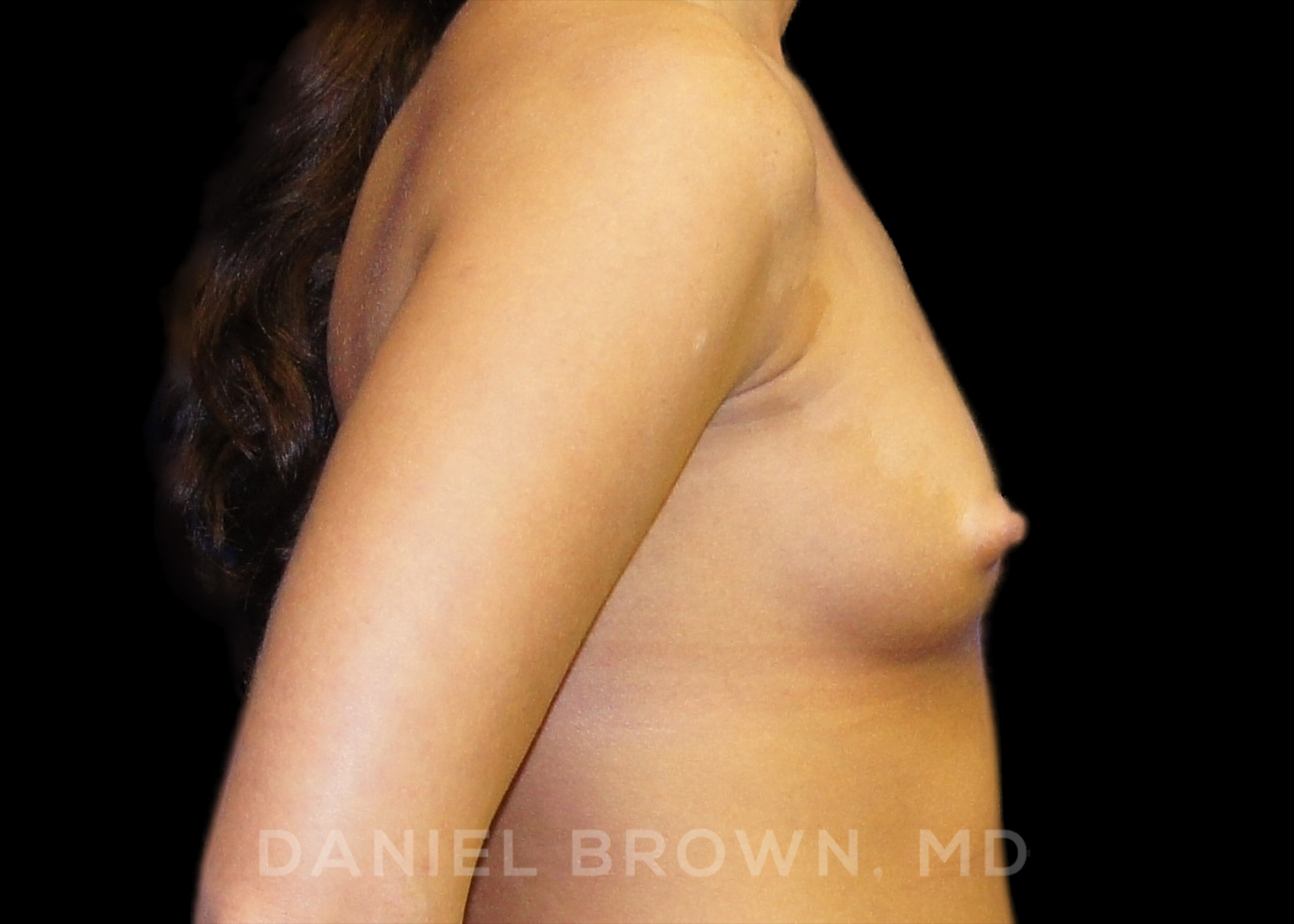 Breast Augmentation Patient Photo - Case 2126 - before view-4